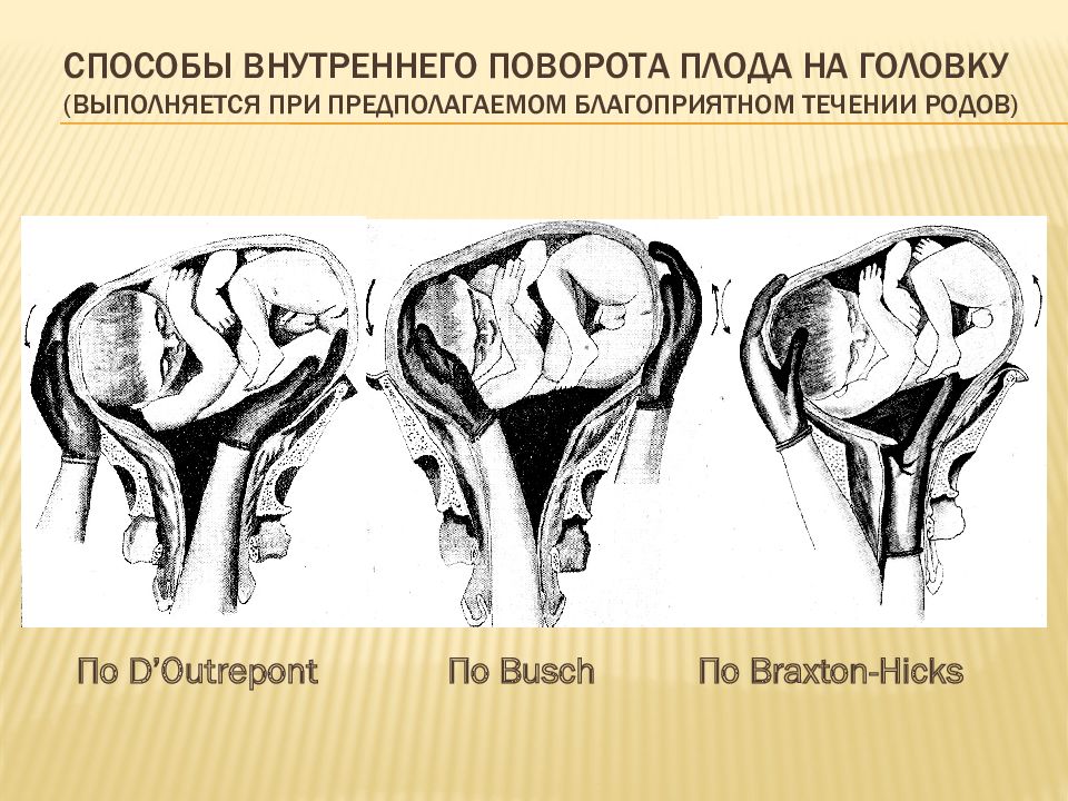 Неправильное положение плода презентация