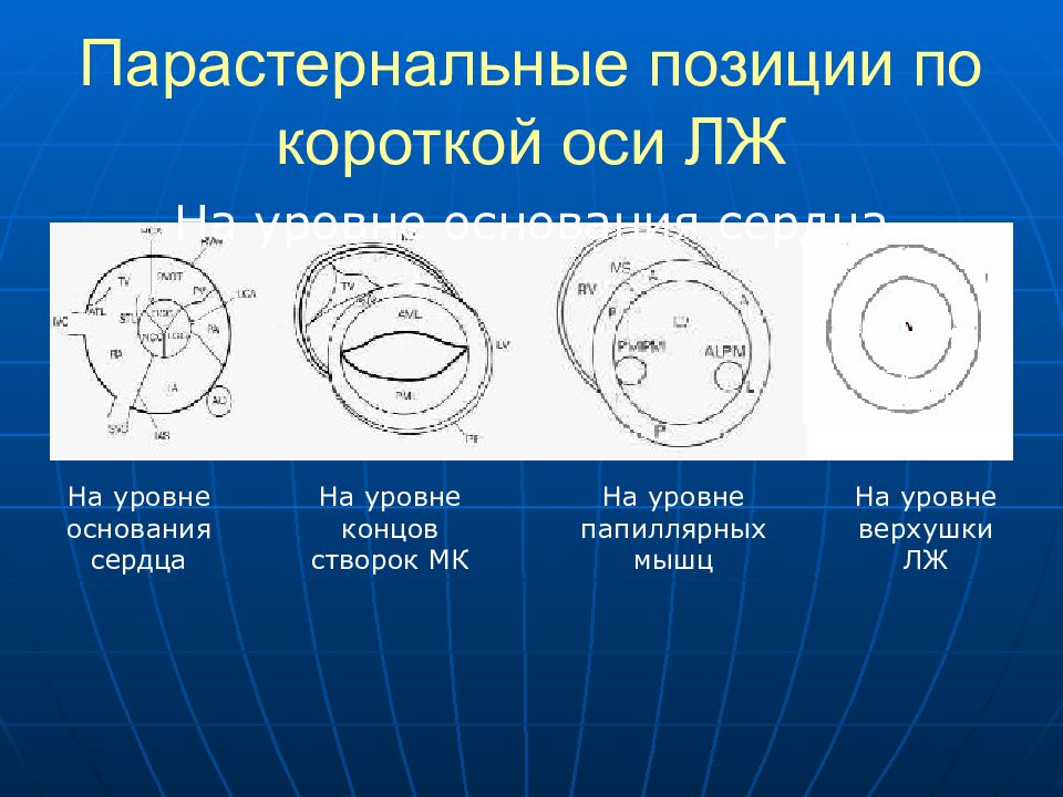 Сегментарное нарушение сократимости стенок лж