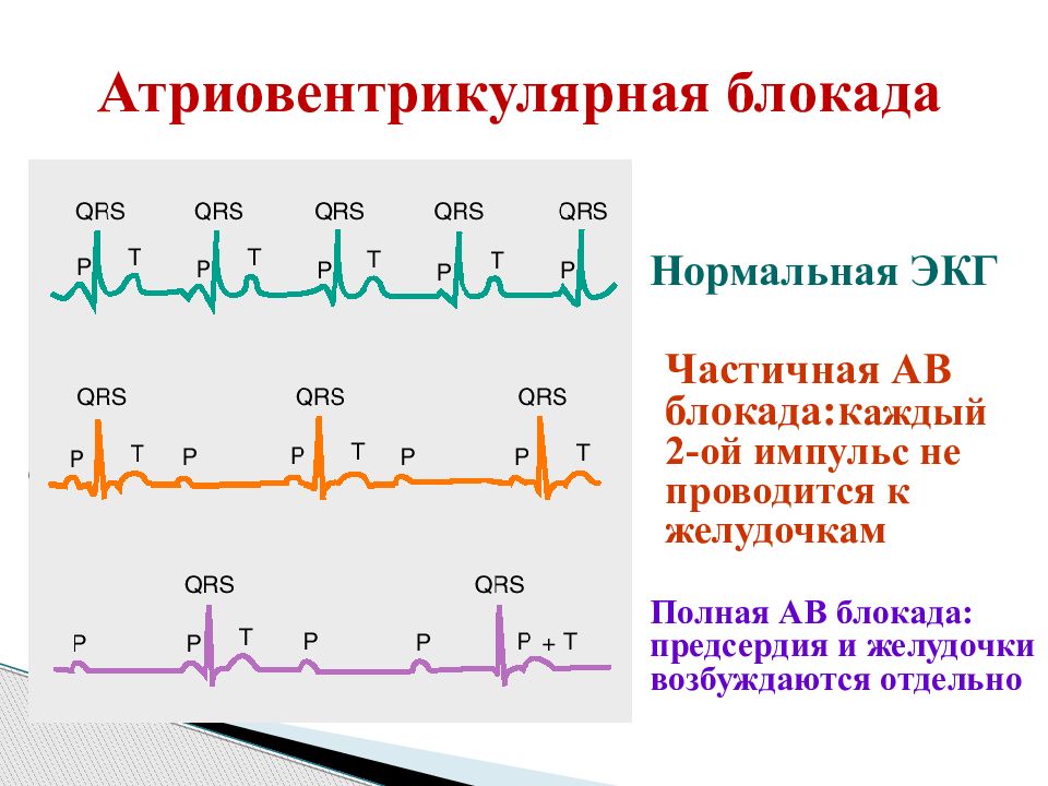 Полная блокада. Полная атриовентрикулярная блокада на ЭКГ. ЭКГ признаки полной av-блокады. Полная АВ блокада на ЭКГ. Неполная атриовентрикулярная блокада на ЭКГ.