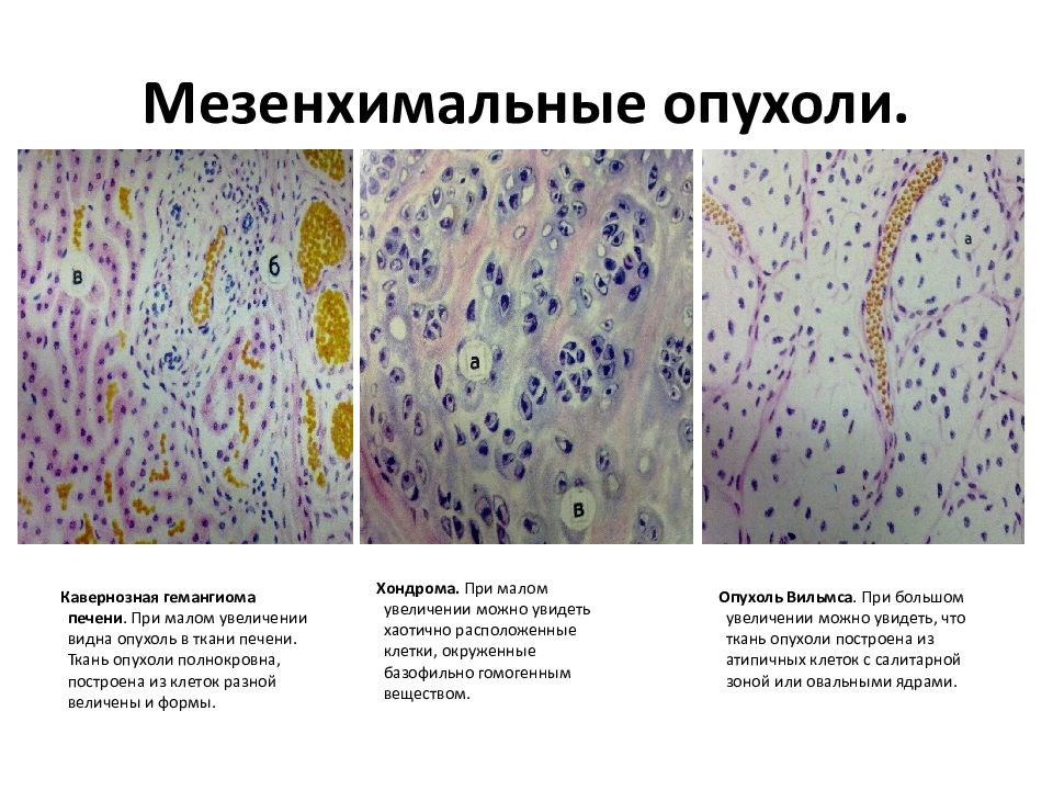 Фиброма пищевода микропрепарат рисунок