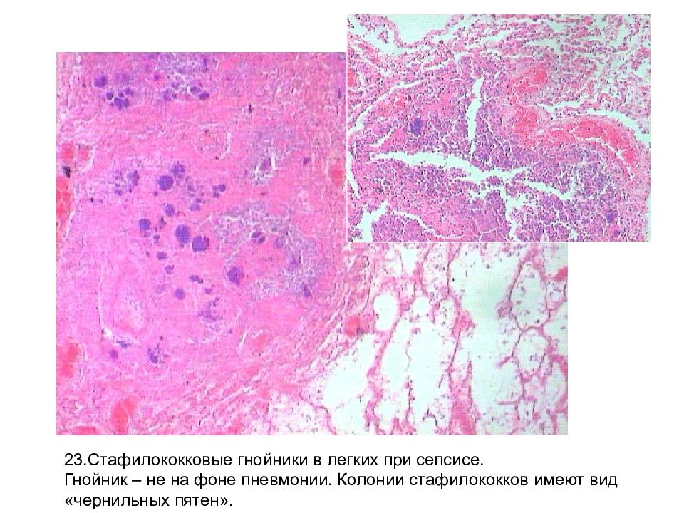 Сепсис легких. Стафилококковый сепсис микропрепарат. Септическая пневмония микропрепарат. Воспаление легких патанатомия макропрепарат. Острый абсцесс легкого микропрепарат.