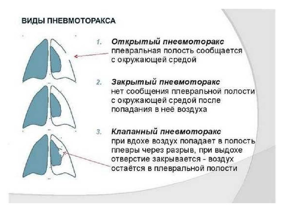 Пневмоторакс картинки для презентации