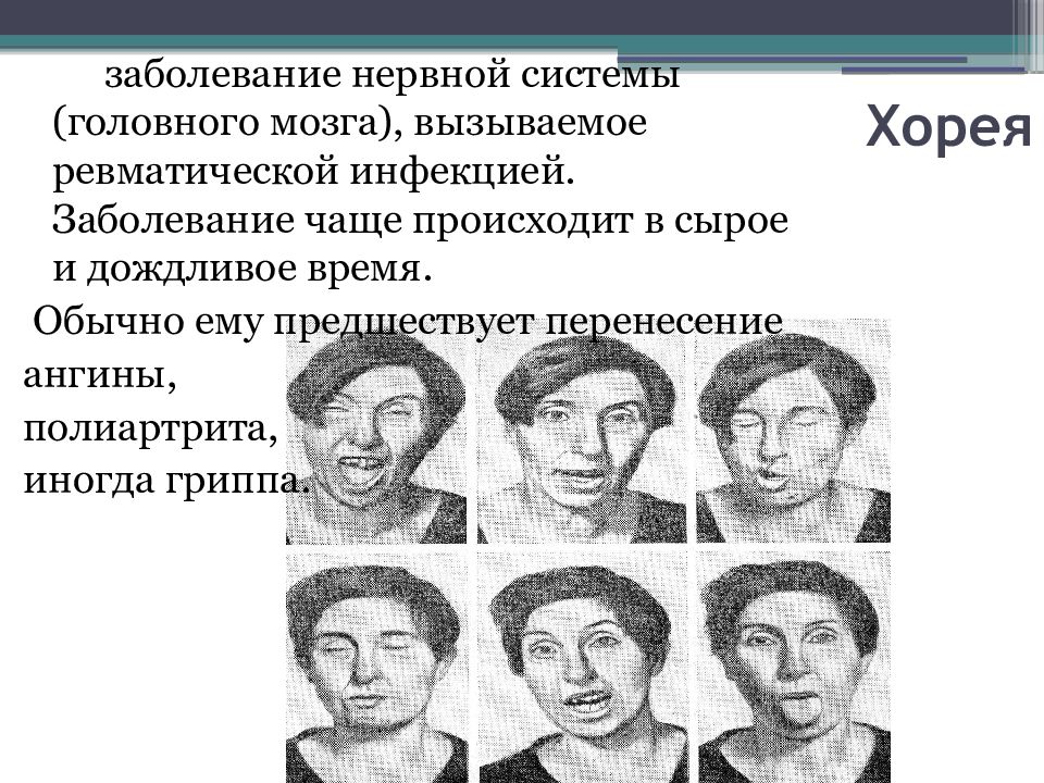 Хорея поражение. Хорея заболевание нервной системы. Хорея Гентингтона. Болезнь Гентингтона.