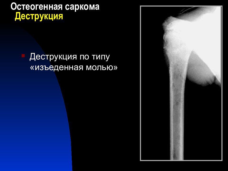 Остеогенная саркома. Остеогенная саркома презентация. Остеогенные саркомы рентгеносемиотика. Остеогенная саркома ключицы.