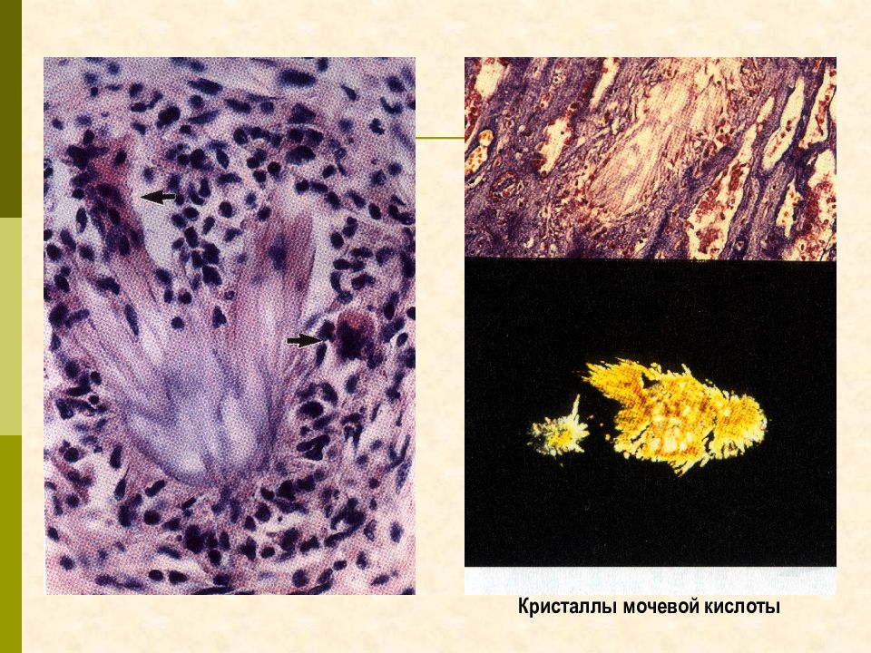Подагра кристаллы мочевой кислоты. Структура мочевой кислоты. Аморфные фосфаты микроскопия мочи. Микроскопия мочи кристаллы мочевой кислоты. Кристаллы мочевой кислоты формула.