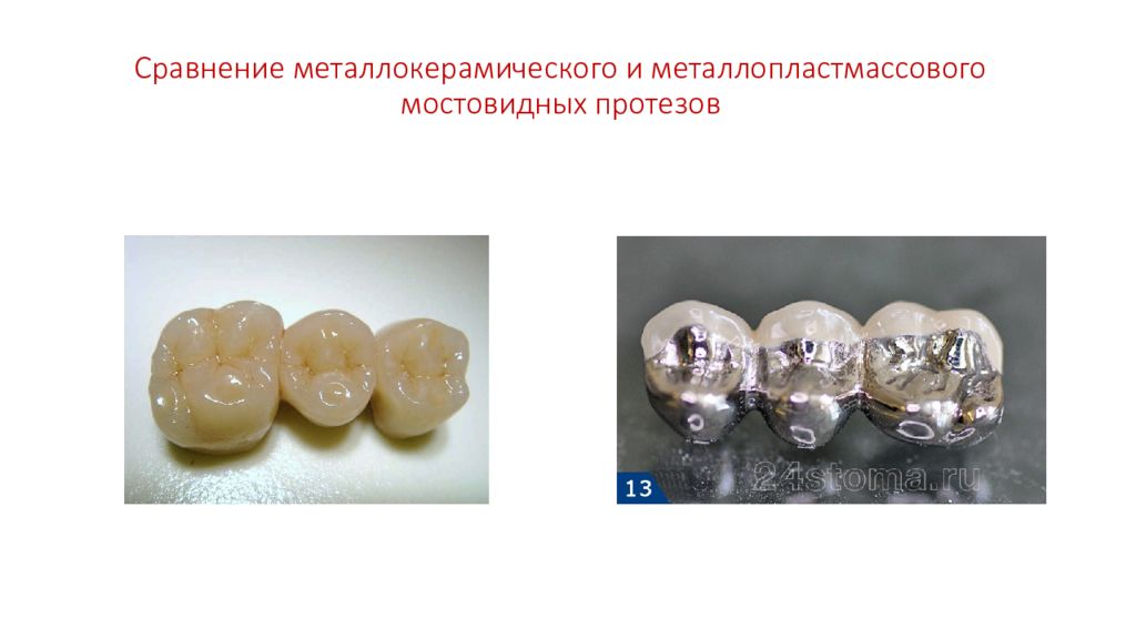 Изготовление мостовидных протезов презентация