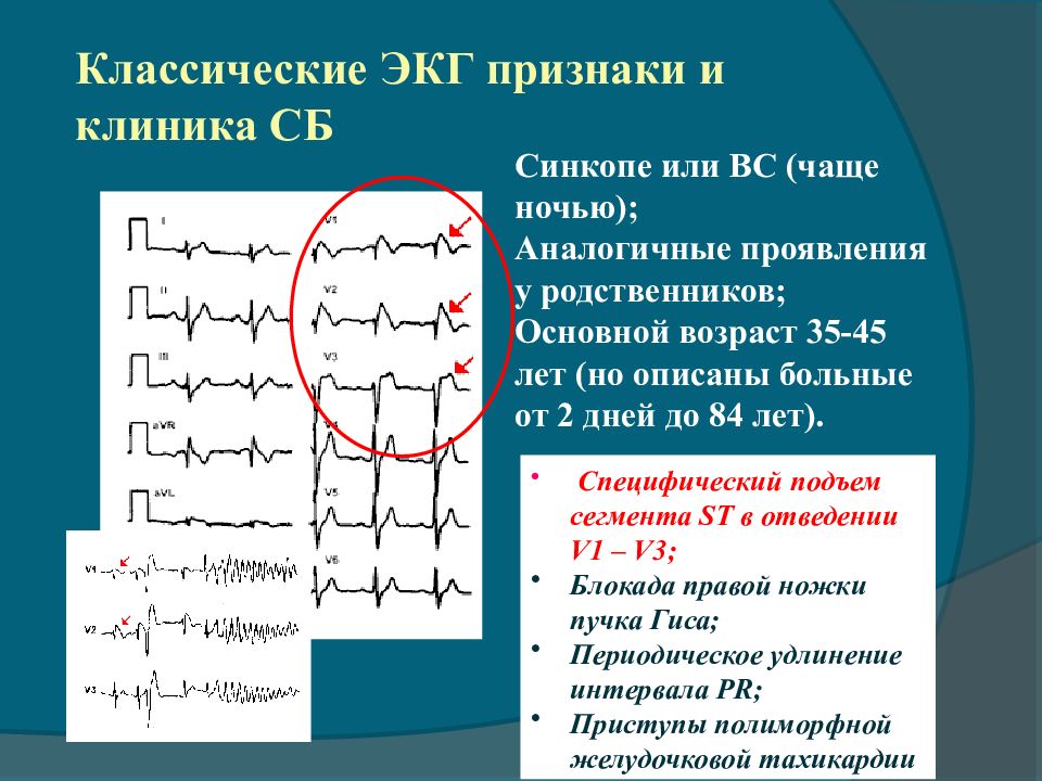 Перед экг. ЭКГ признаки внезапной смерти. Внезапная сердечная смерть ЭКГ. Синкопальные состояния на ЭКГ. Признак внезапной смерти на ЭКГПРИЗНАК внезапной смерти на ЭКГ.