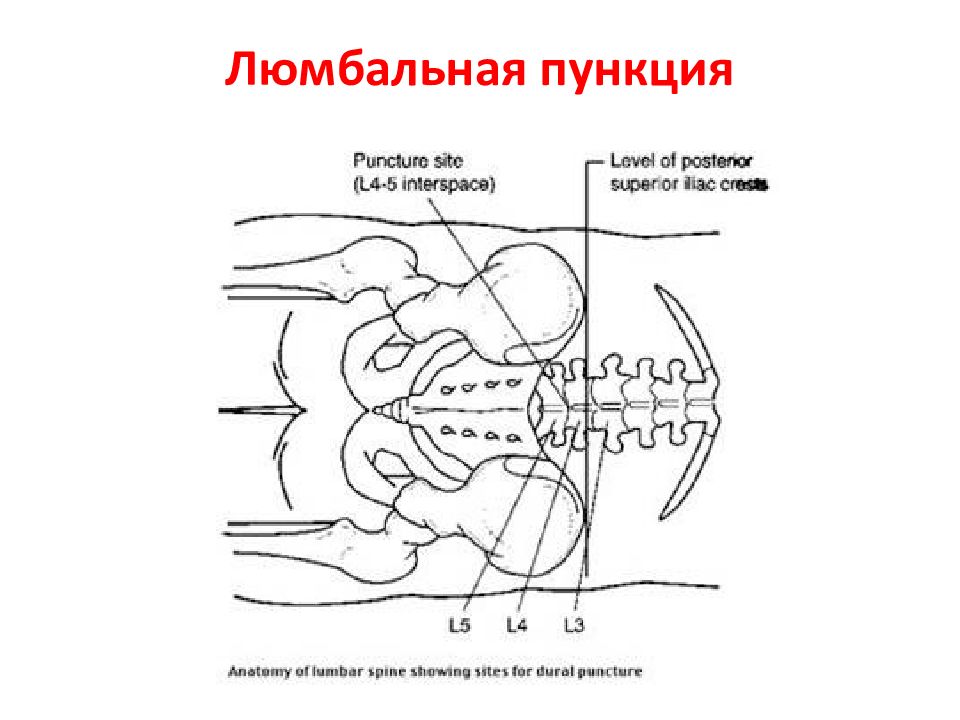 Пункция спинного мозга. Место люмбальной пункции. Санационные люмбальные пункции. Направление на спинномозговую пункцию.