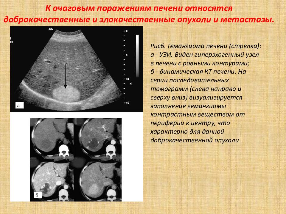 Сколько живут с метастазами