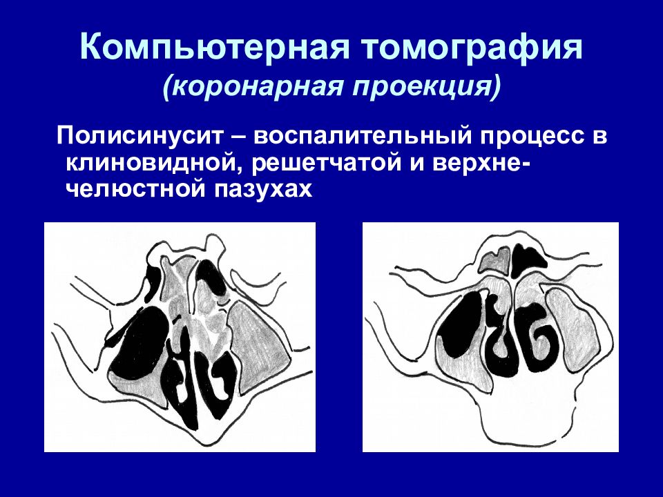 Проекция пазух. Кт околоносовых пазух аксиальная проекция. Кт околоносовых пазух коронарная проекция. Клиновидная пазуха на кт. Кт околоносовых пазух в аксиальной и коронарной проекциях.