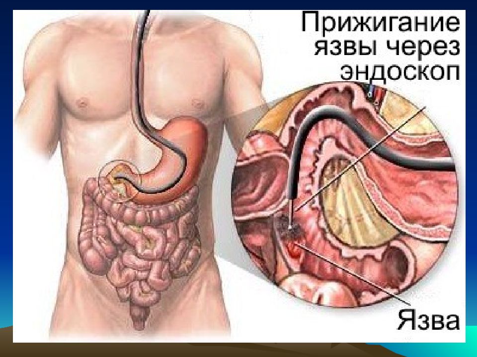 Врач проверяющий желудок и кишечник. Язвенная болезнь желудка и ДПК презентация.