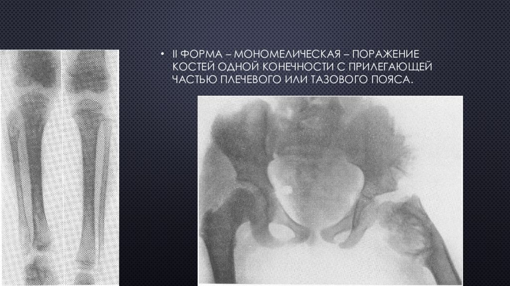 Поражение костей. Дисхондроплазия бедренной кости. Дисхондроплазия большеберцовой кости. Дисхондроплазия болезнь Олье.