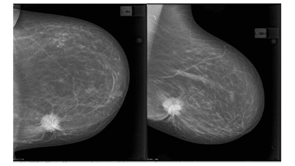 Маммография старый. Липома молочной железы маммограмма. Фибролипома маммография. Фибролипома молочной железы рентген. Фиброаденома молочной железы рентген.