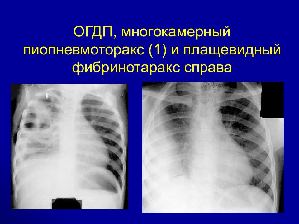 Острая гнойная деструктивная пневмония у детей презентация