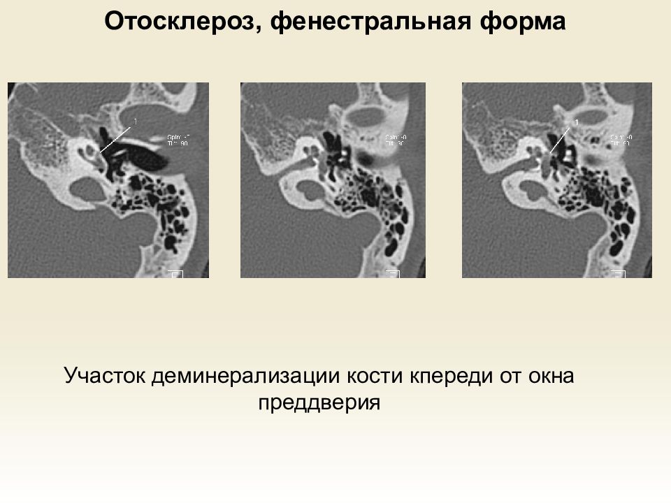 Отосклероз по утвержденным клиническим рекомендациям. Отосклероз компьютерная томография. Фенестральный отосклероз на кт. Кт височных костей при отосклерозе. Кохлеарный отосклероз на кт.