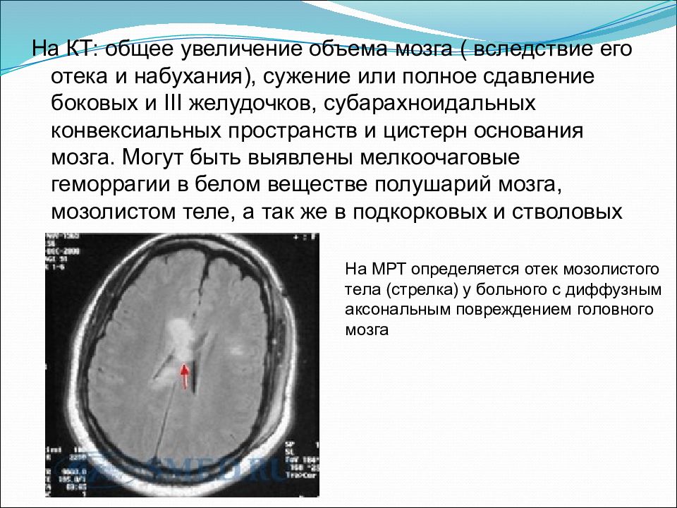 Причины сужения головного мозга