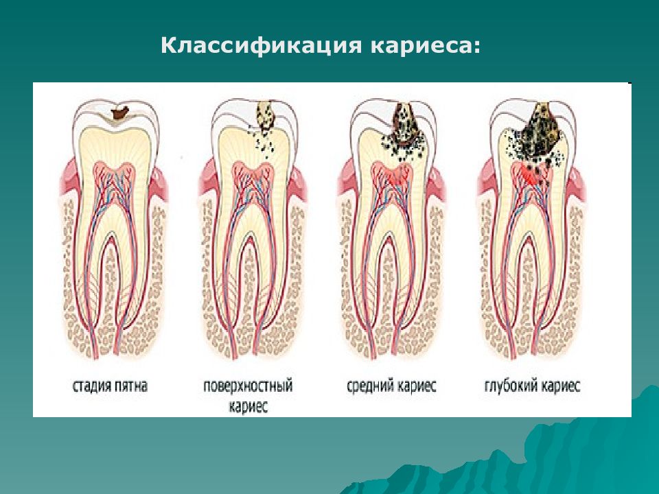 Классификация кариеса презентация