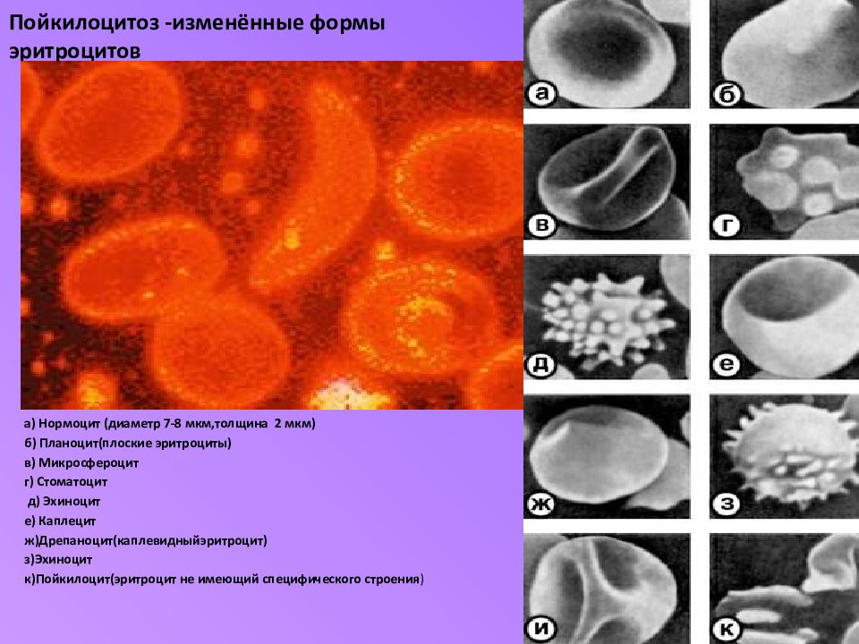 Форма эритроцитов. Формы эритроцитов пойкилоцитоз. Эхиноциты эритроциты. Изменение формы эритроцитов крови. Эритроциты шиповатой формы.