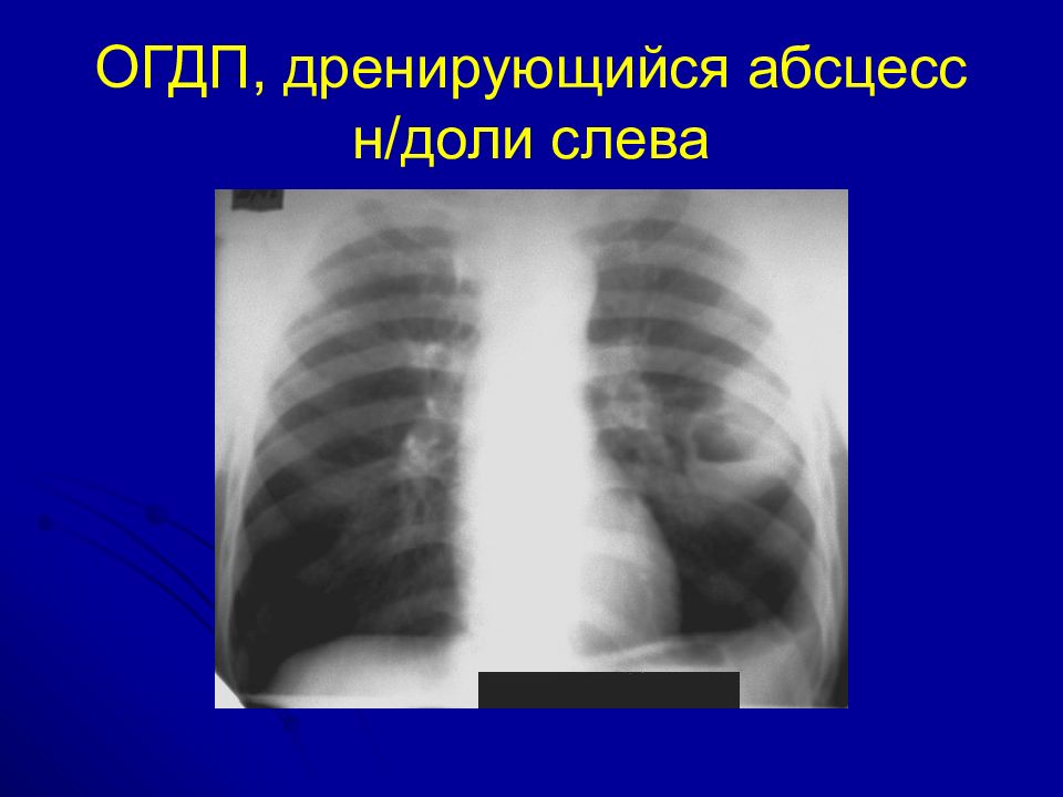 Деструктивная пневмония у детей презентация