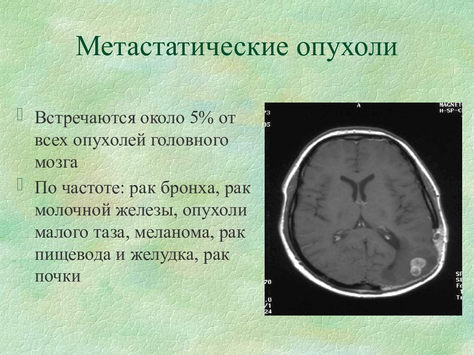 Опухоль мозга презентация