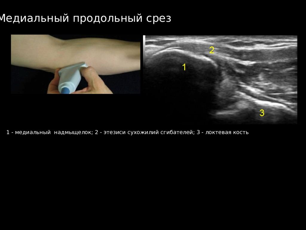 Узи нервов. Локтевой сустав УЗИ Диагностер. УЗИ мягких тканей локтевого сустава протокол. Эпикондилит локтевого сустава на УЗИ протокол. Медиальный эпикондилит локтевого сустава УЗИ.
