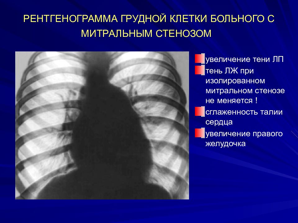 Митральный стеноз картинка