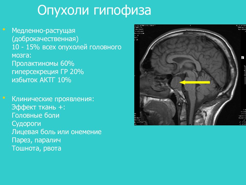 Презентация на тему заболевания гипофиза