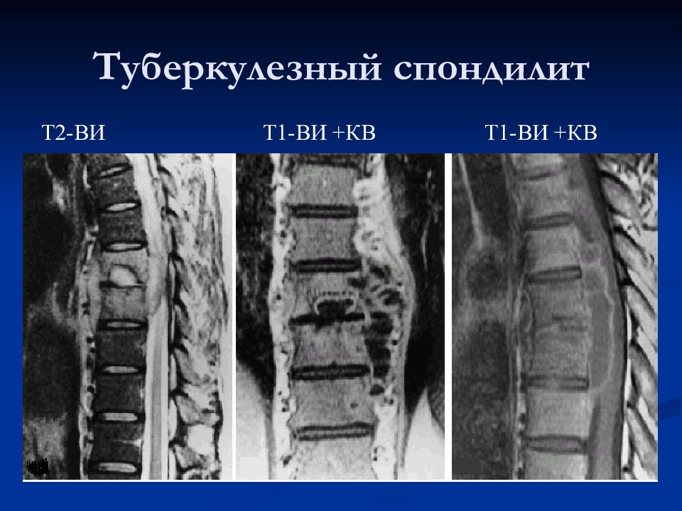 Туберкулез позвоночника презентация