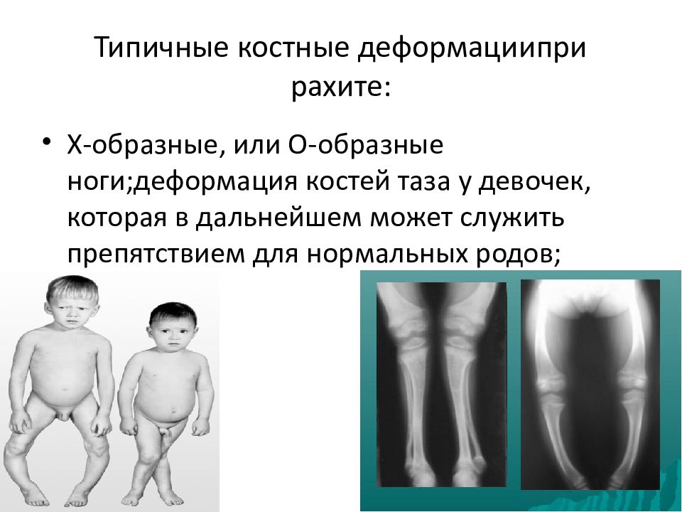 Причины заболевания рахита. Костные проявления рахита. Рахит деформации костей. Деформация конечностей при рахите.