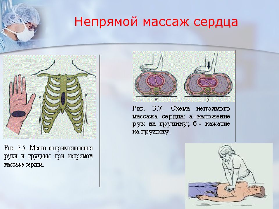 Ошибки при проведении ytghzvjuj vfccf;f c. Методика непрямого массажа сердца. Типичные ошибки при проведении непрямого массажа сердца. Непрямой массаж сердца ошибки. Непрямой массаж сердца ошибки.