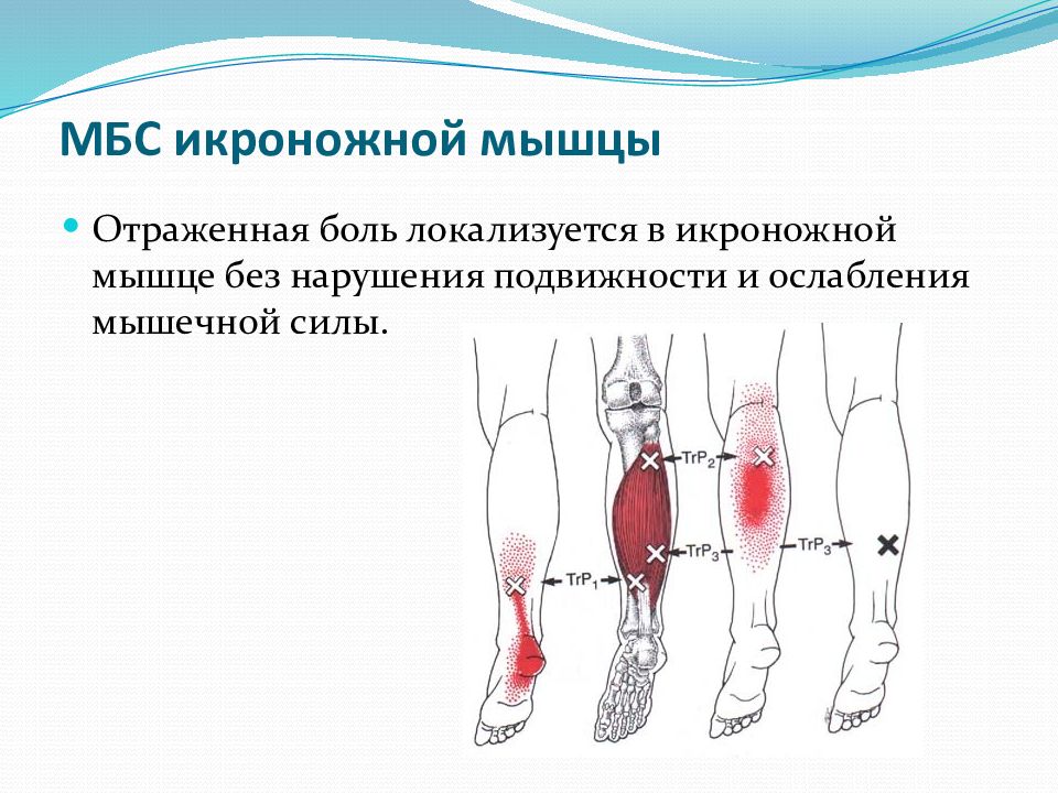 Икроножная мышца какая ткань. Миофасциальный болевой синдром. Узел в икроножной мышце. Миофасциальный синдром мкб. Нарушена подвижность ноги.