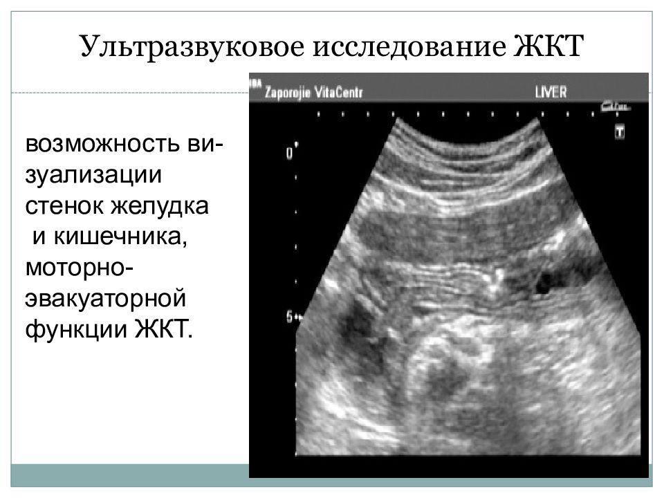 Узи в каменском. Ультразвуковое исследование желудка. УЗИ моторно эвакуаторной функции желудка.