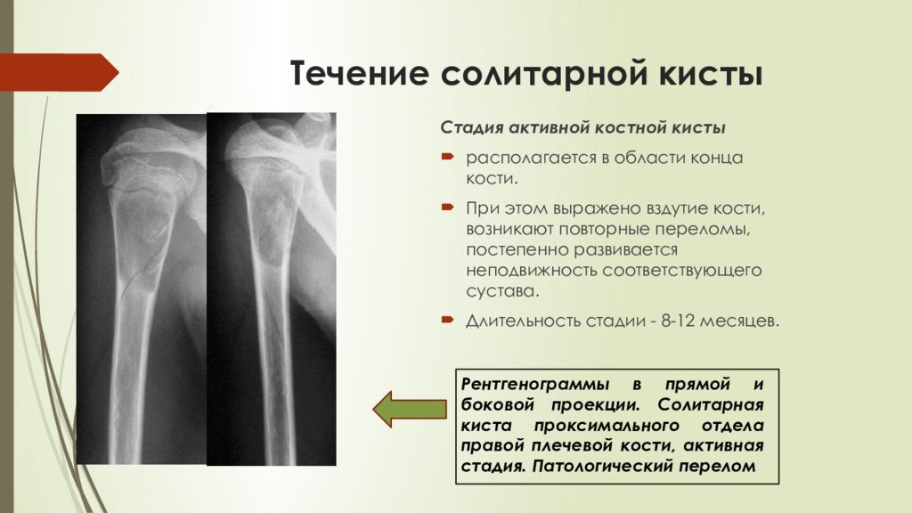 Разряжение костной ткани. Киста лучевой кости рентген. Костная киста дистального метаэпифиза бедренной кости. Внутрикостная киста бедренной кости. Киста шейки бедренной кости на рентгене.