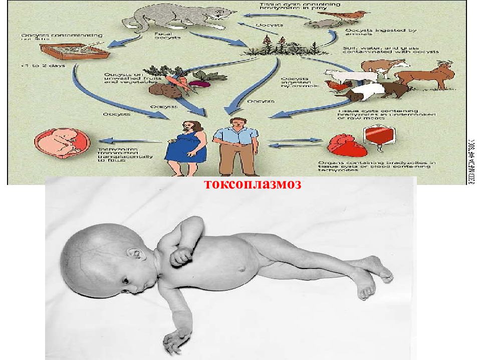 Презентация токсоплазмоз у детей