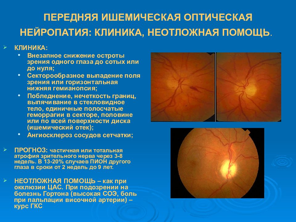 Клиническая картина задней ишемической оптиконейропатии