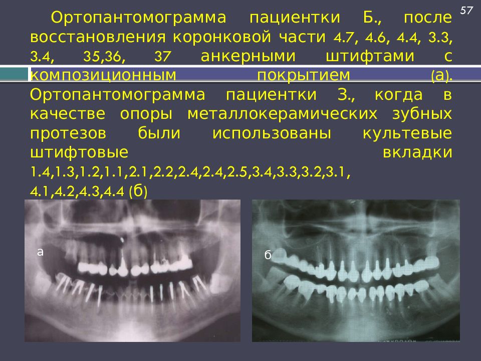 Ортопантомограмма пациентки Б., после восстановления коронковой части 4.7, 4.6, 4.4, 3.3, 3.4, 35,36, 37 анкерными штифтами с композиционным покрытием (а).