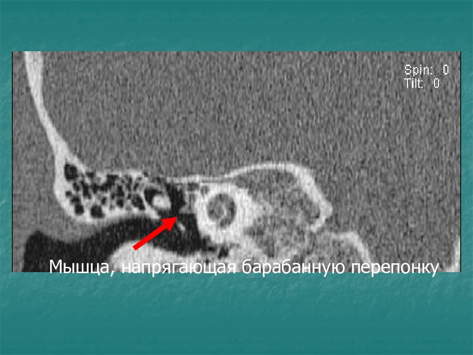 Мышца напрягающая барабанную. Мышца напрягающая барабанную перепонку кт. Кт височных костей перфорация. Барабанная перепонка на кт. Сухожилие мышцы напрягающей барабанную перепонку.