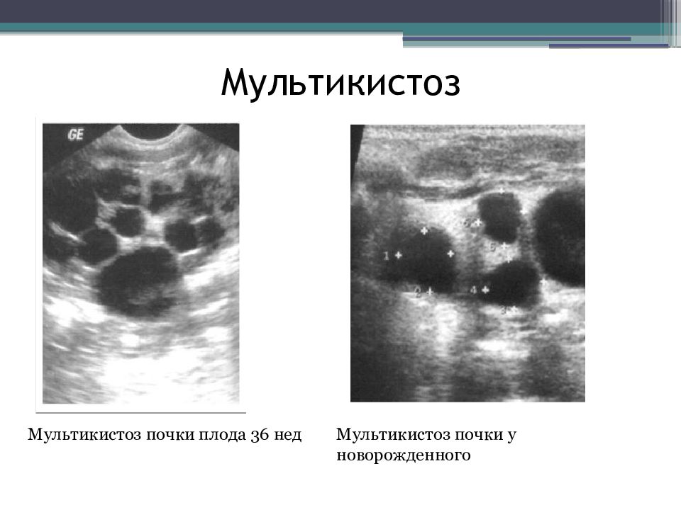 Поликистоз почек на узи. Мультикистозная дисплазия почки. Мультикистозная дисплазия почки на УЗИ. Мультикистоз и поликистоз почек у новорожденных.