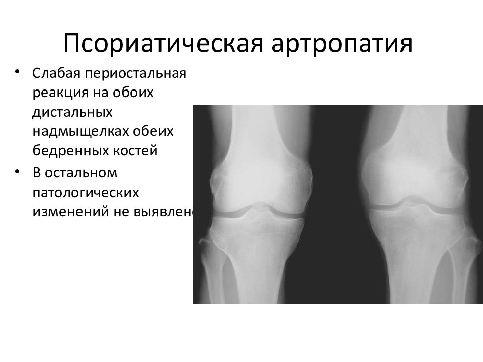 Пирофосфатная артропатия