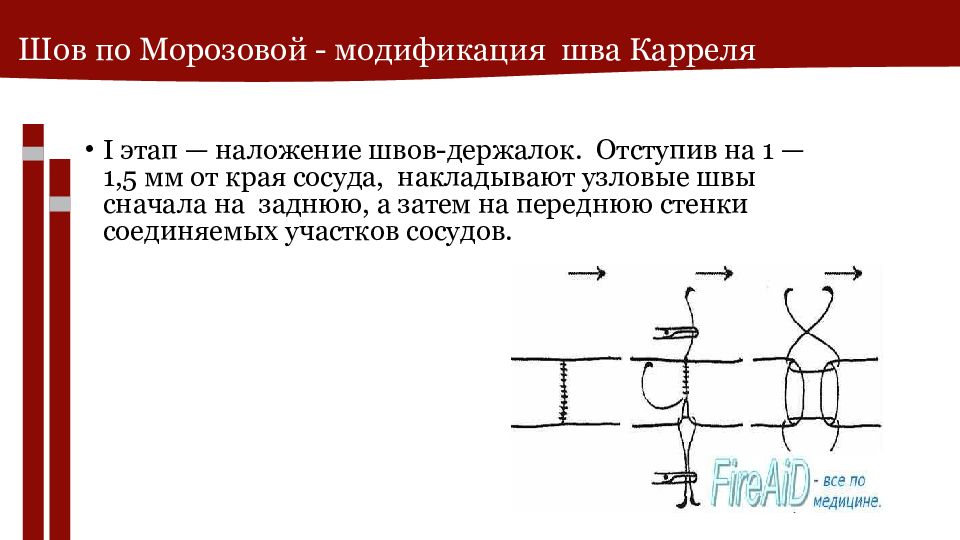 Швы в хирургии презентация