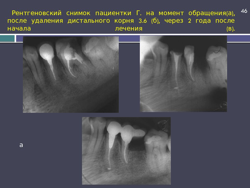 Рентгеновский снимок пациентки Г. на момент обращения(а), после удаления дистального корня 3.6 (б), через 2 года после начала лечения (в).