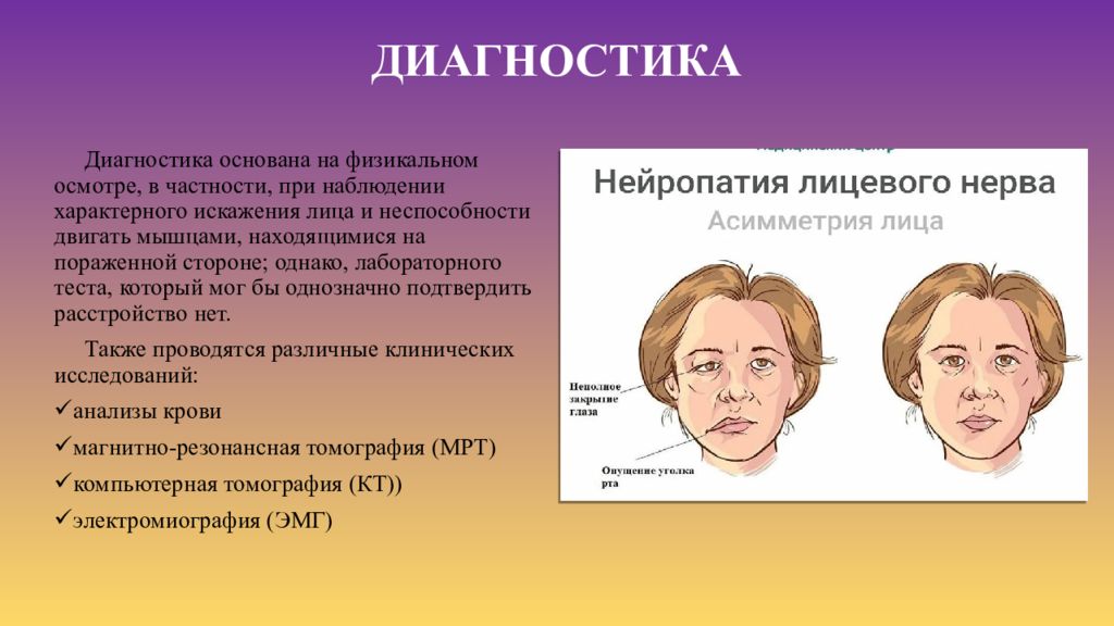 Паралич белла презентация