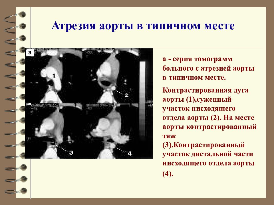 Характерным местом. Стеноз или атрезия аорты.