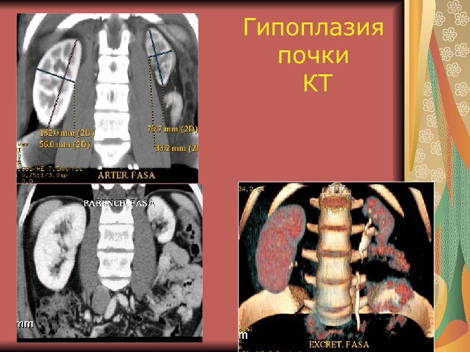 Гипоплазия почки. Гипоплазия почки рентген. Двусторонняя гипоплазия почек.