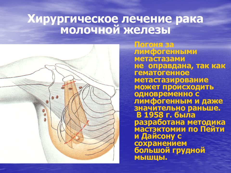 Радикальная мастэктомия