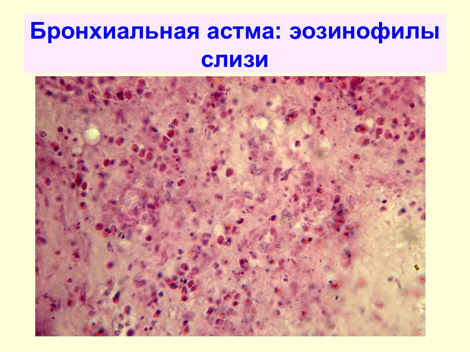 Эозинофилия при астме. Эозинофилы в мокроте микроскопия. Эозинофильный васкулит. Эозинофилы в мокроте при бронхиальной астме.