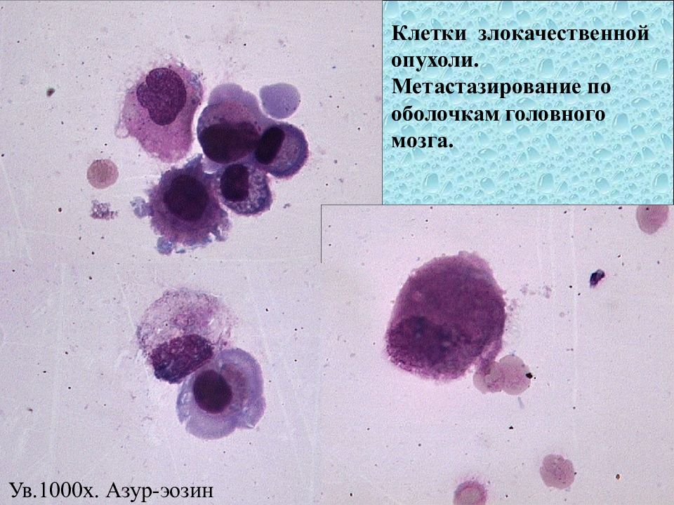 Исследование ликвора презентация