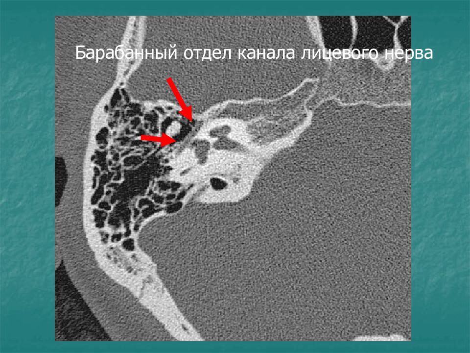 Кт лицевых костей. Сосцевидный отросток височной кости кт. Кт анатомия пирамид височных костей. Тип строения сосцевидного отростка височной кости кт. Перелом пирамиды височной кости кт.