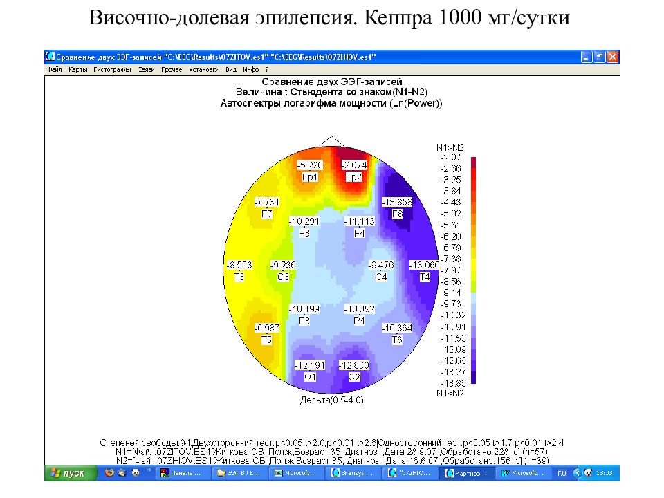 Мг сутки. Височно долевая эпилепсия. Височно долевая эпилепсия чем опасна и Продолжительность жизни.