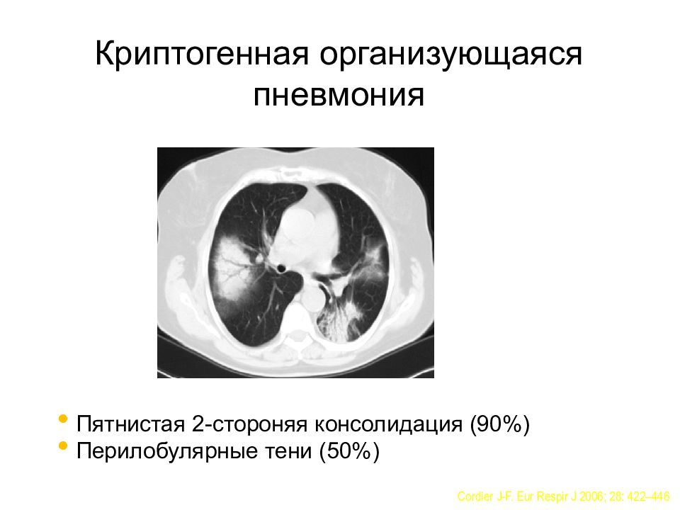 Криптогенная организующаяся пневмония — Википедия